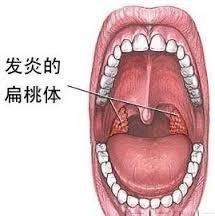 九个月宝宝扁桃体发炎怎么办？全面解析应对之策