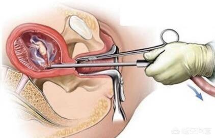 五个月可以堕胎吗，关于孕期选择与医学考量