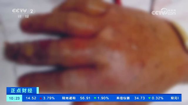 澳门知识专家解析，伤口结痂一个月未愈合的原因与处理方法